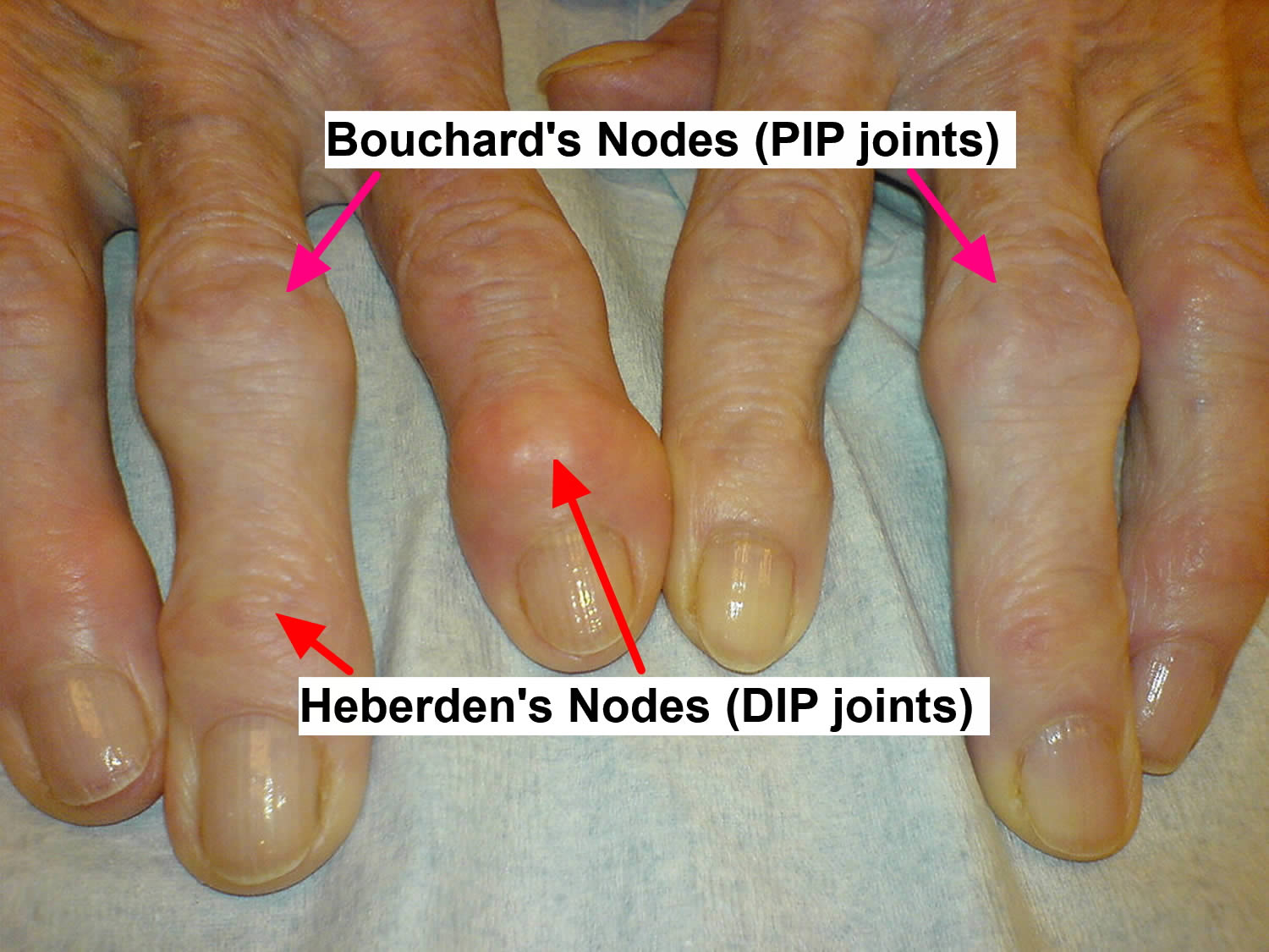 Osteoarthritis Causes Symptoms Diagnosis Prognosis And Treatment