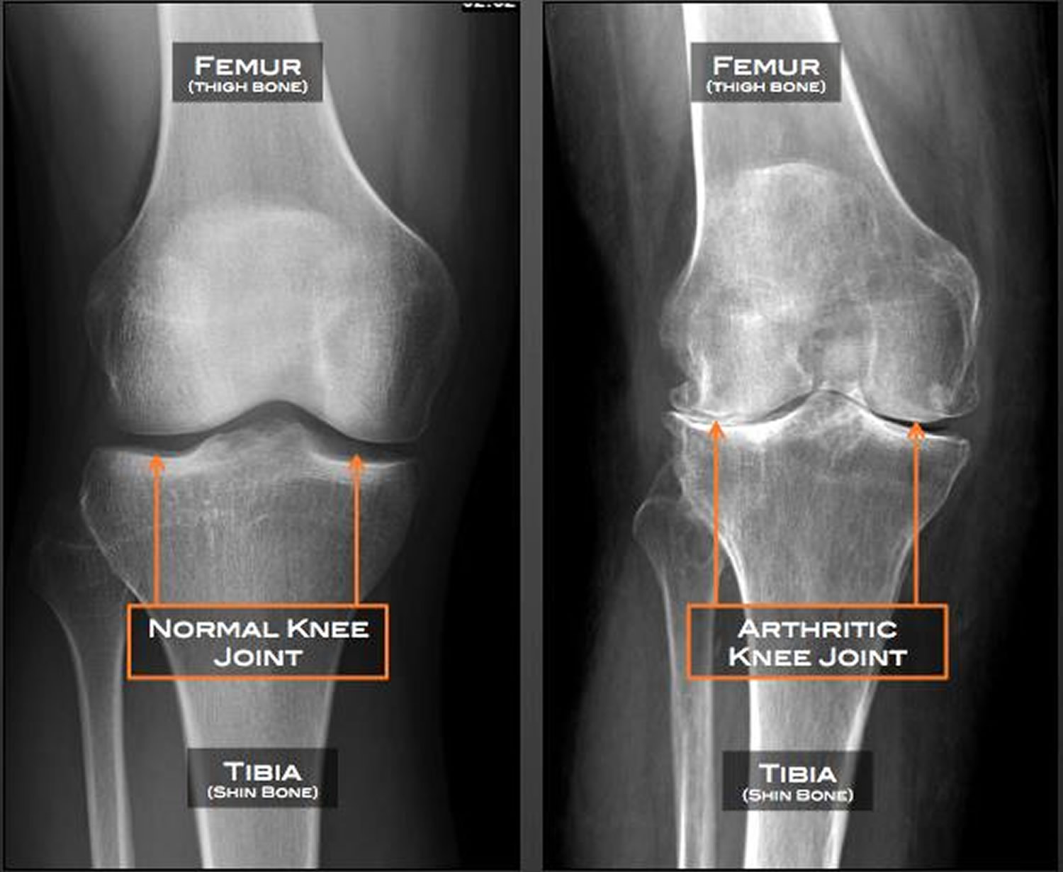 xray of normal hip joint vs osteoarthritic