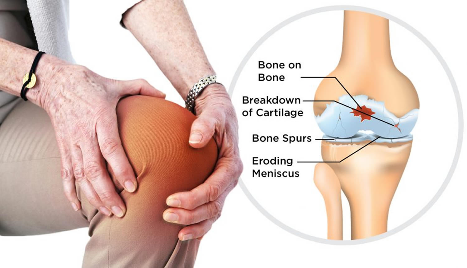 best Arthritis treatment in Kenya