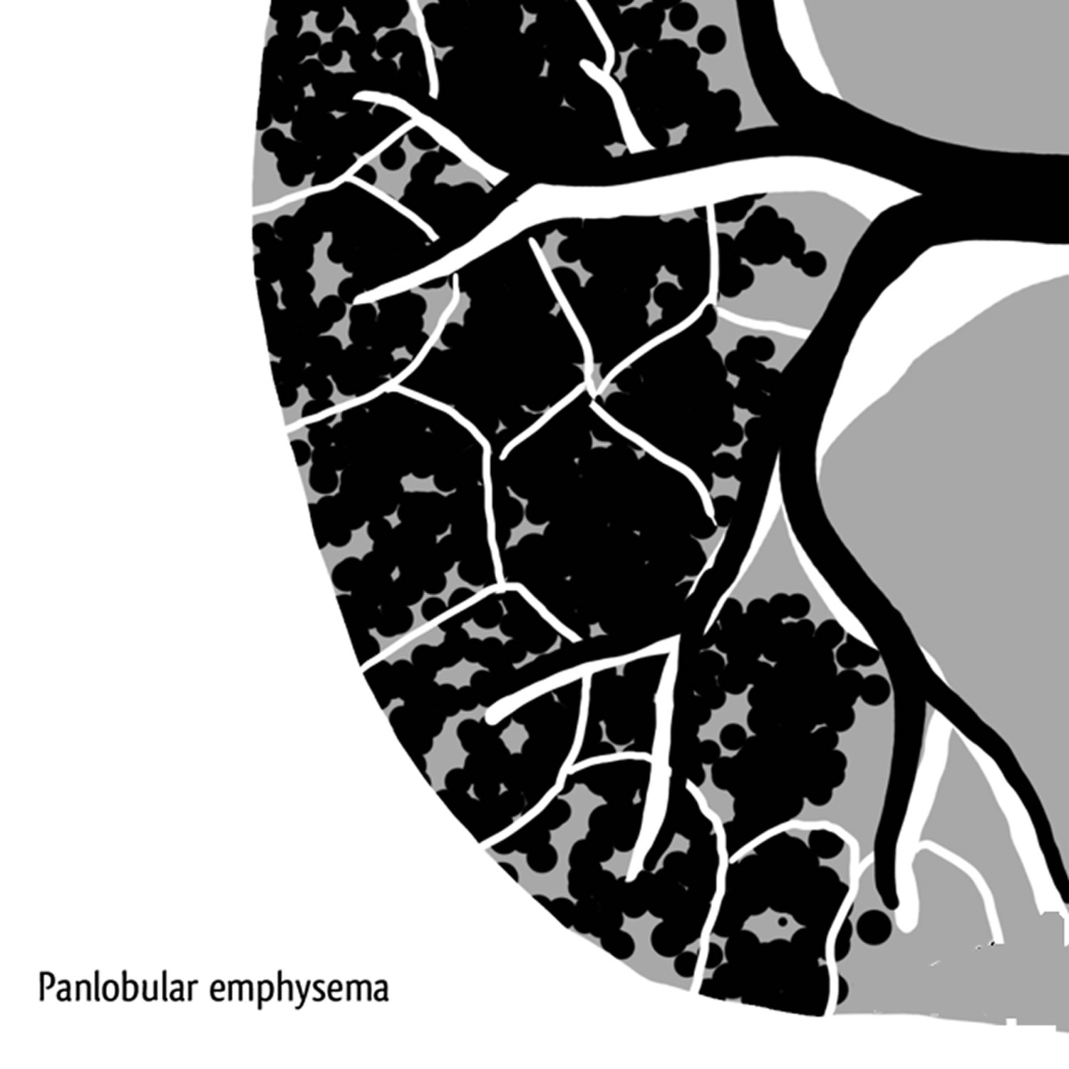 panlobular emphysema