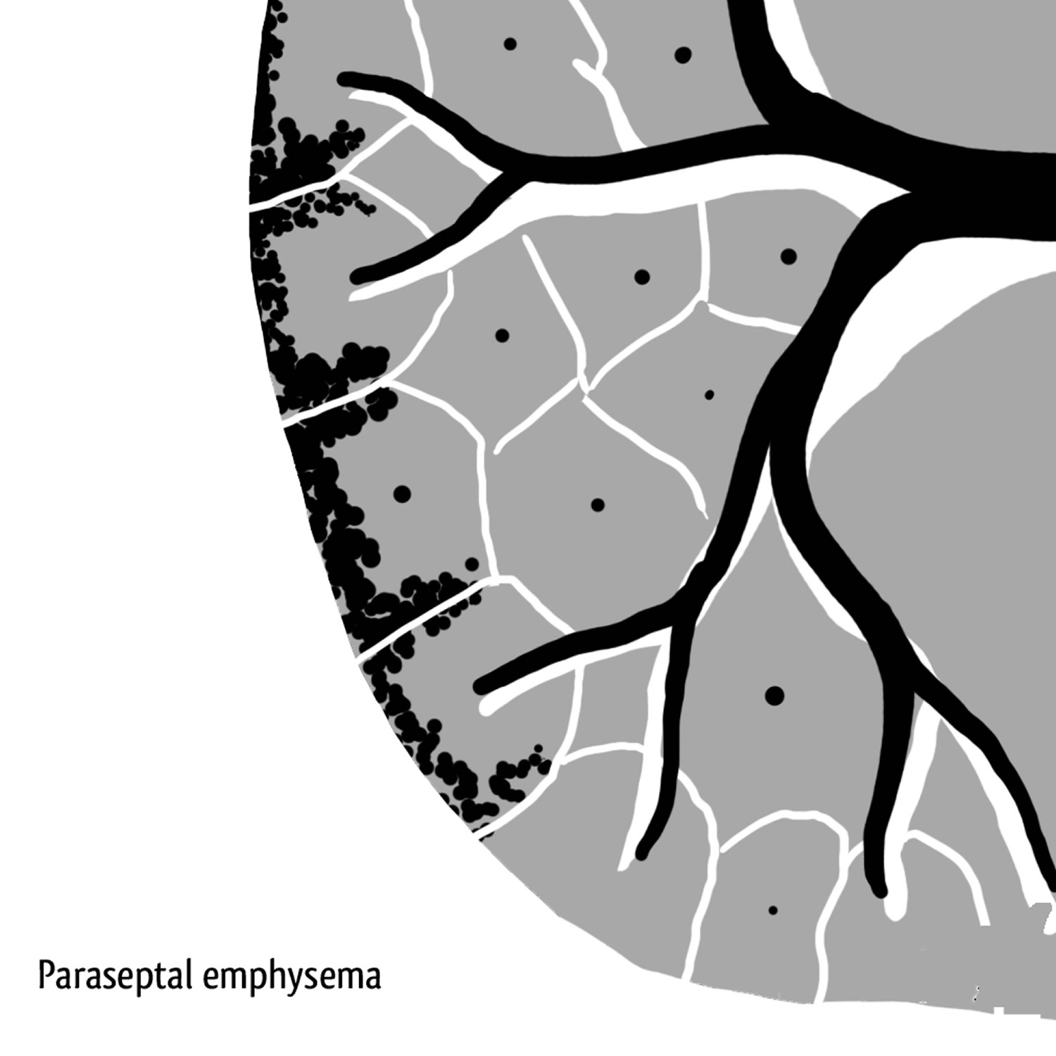 paraseptal emphysema