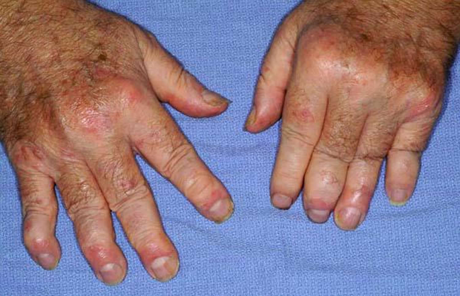 Psoriatic Arthritis Hand 2 
