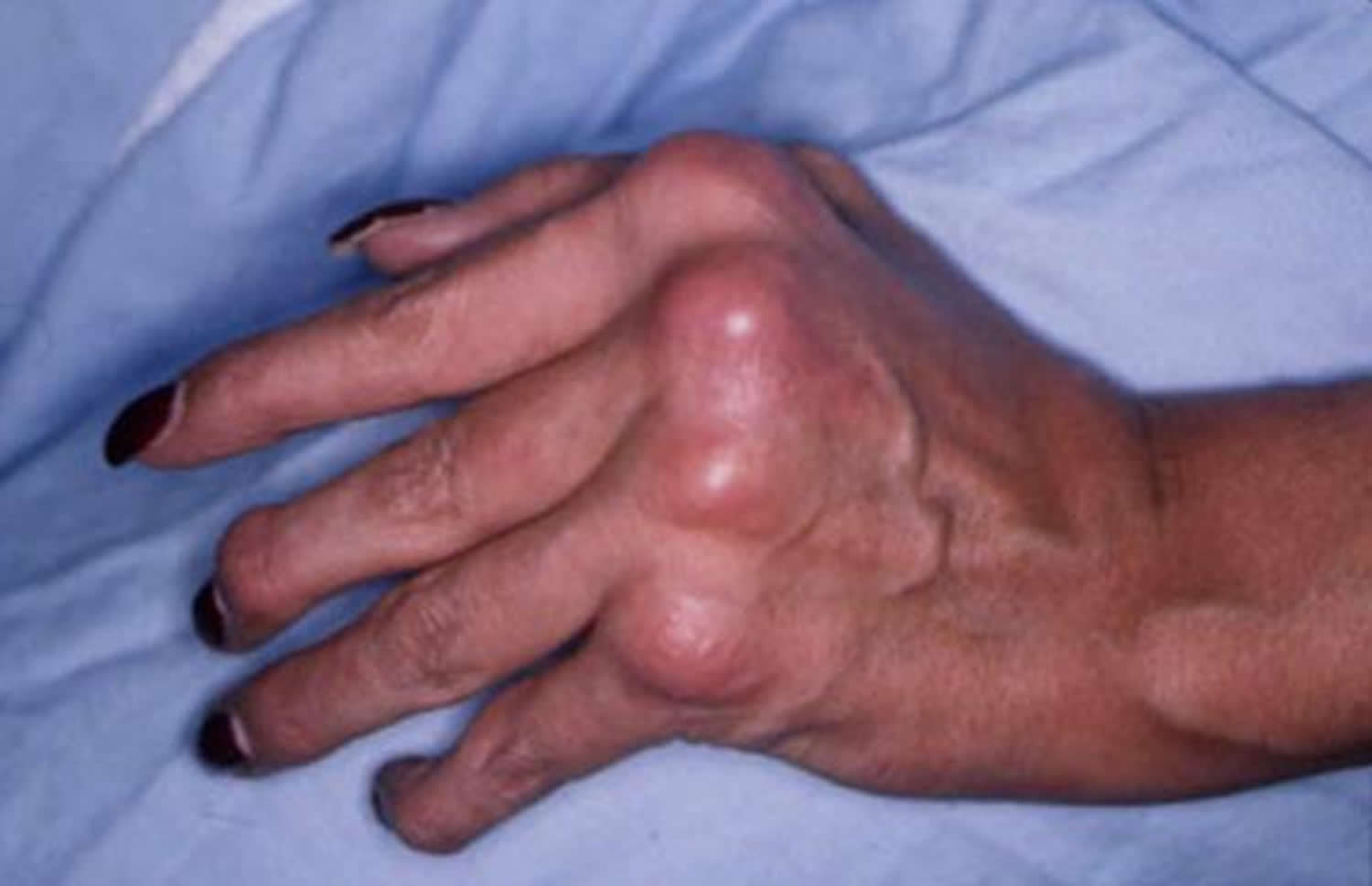 psoriatic arthritis hand