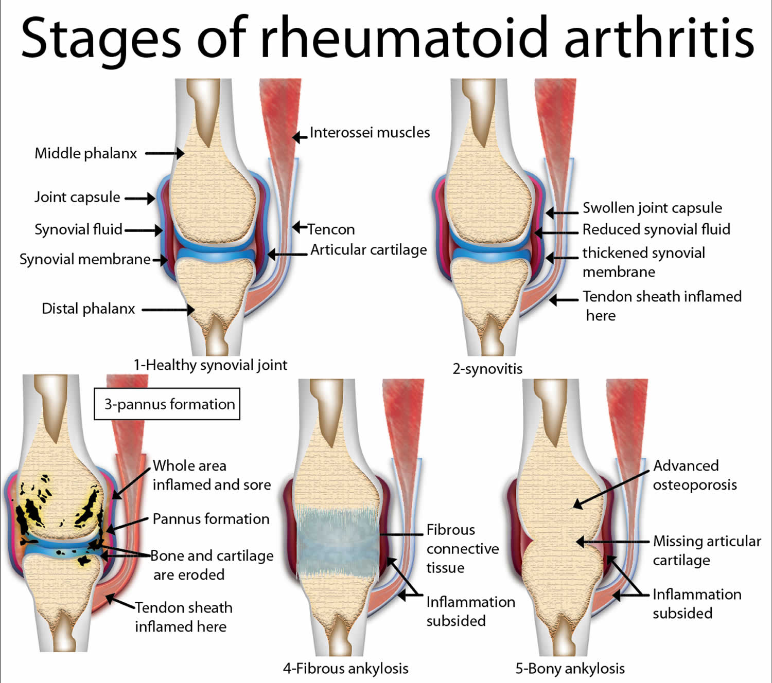 rheumatoid arthritis stages