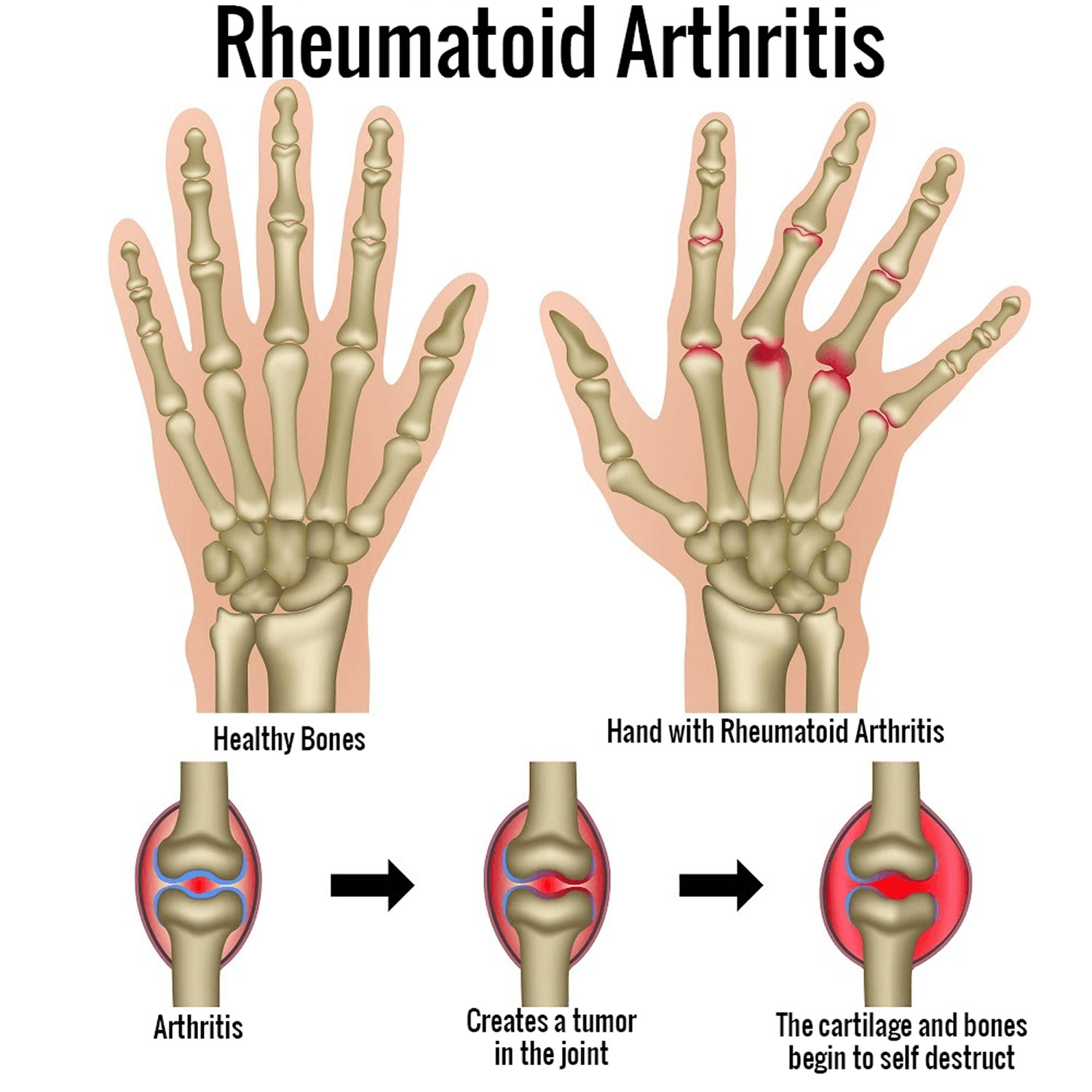 Rheumatoid Arthritis - Causes, Signs, Symptoms, Diet, Treatment