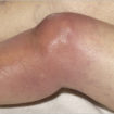 septic arthritis