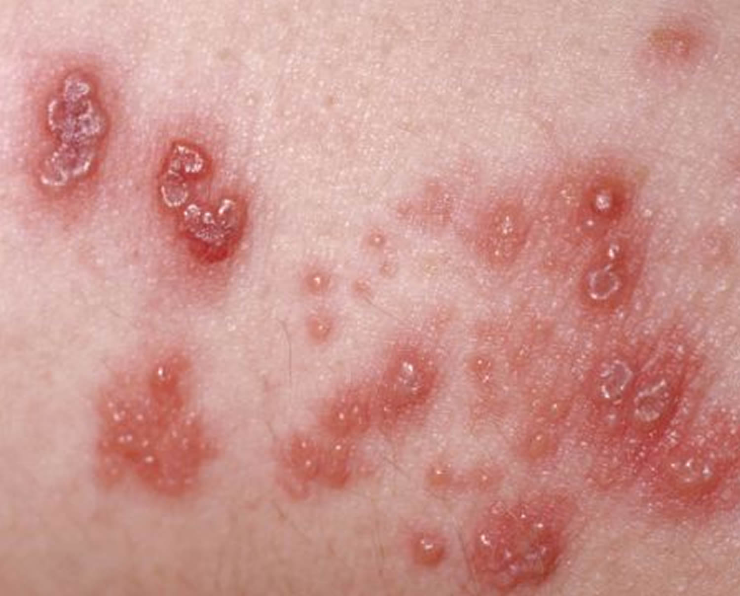 Describe Shingles Rash Dermatology