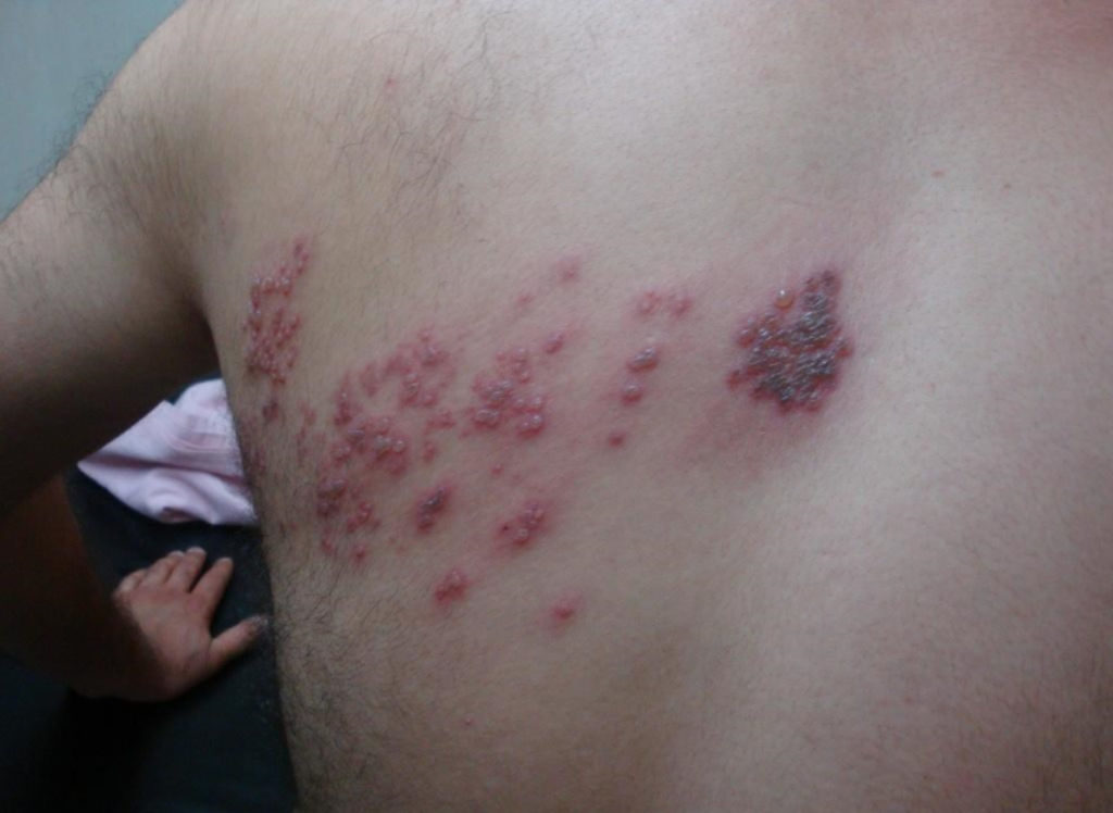 Shingles - Causes, Symptoms, Home Remedies, Treatment