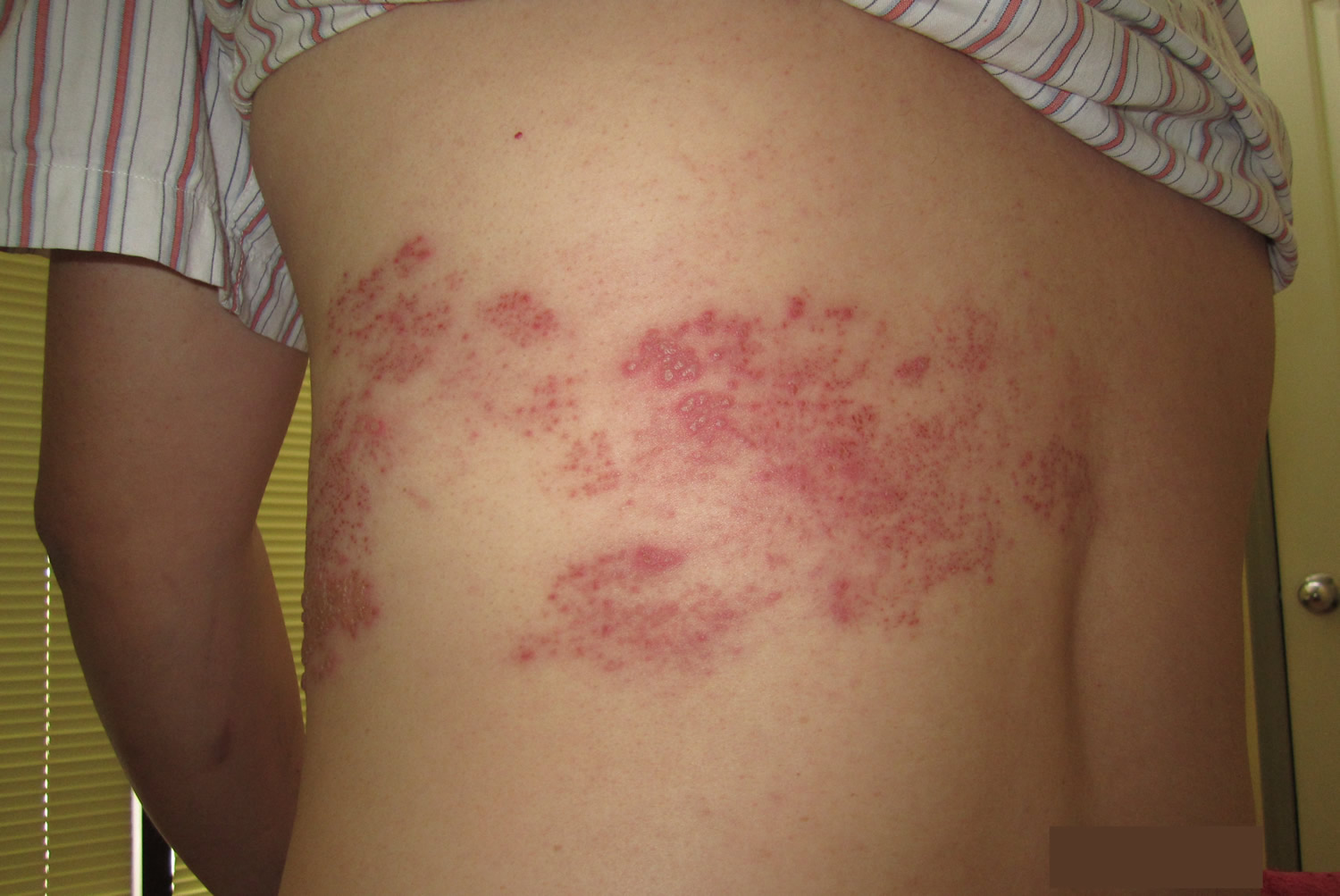 Pictures Of Shingles Rash On Body   Shingles Rash On Body 