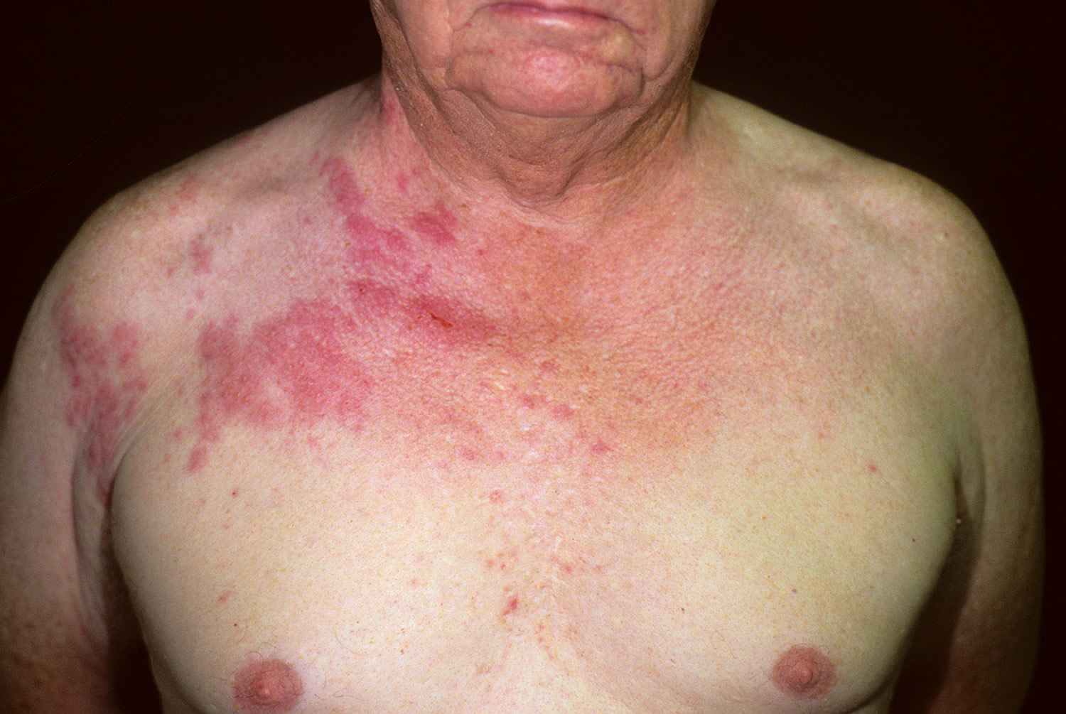 Shingles Causes, Symptoms, Home Remedies, Treatment