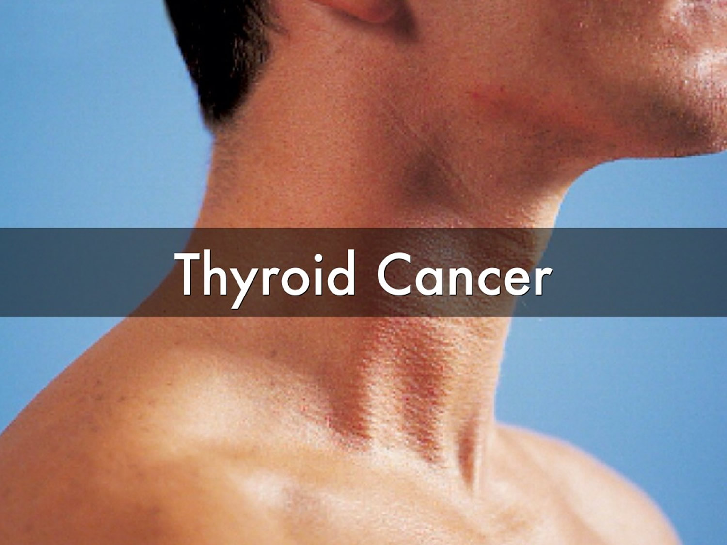 Is There Always A Lump With Thyroid Cancer