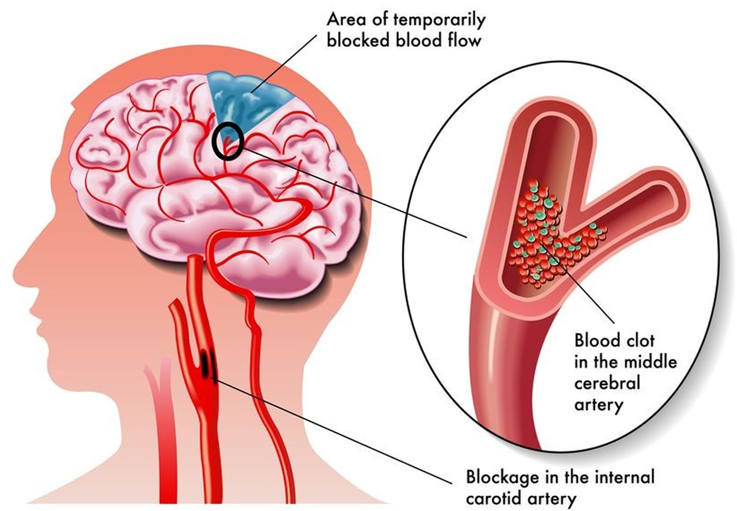 ischemic-stroke-causes-signs-symptoms-ischemic-stroke-treatment