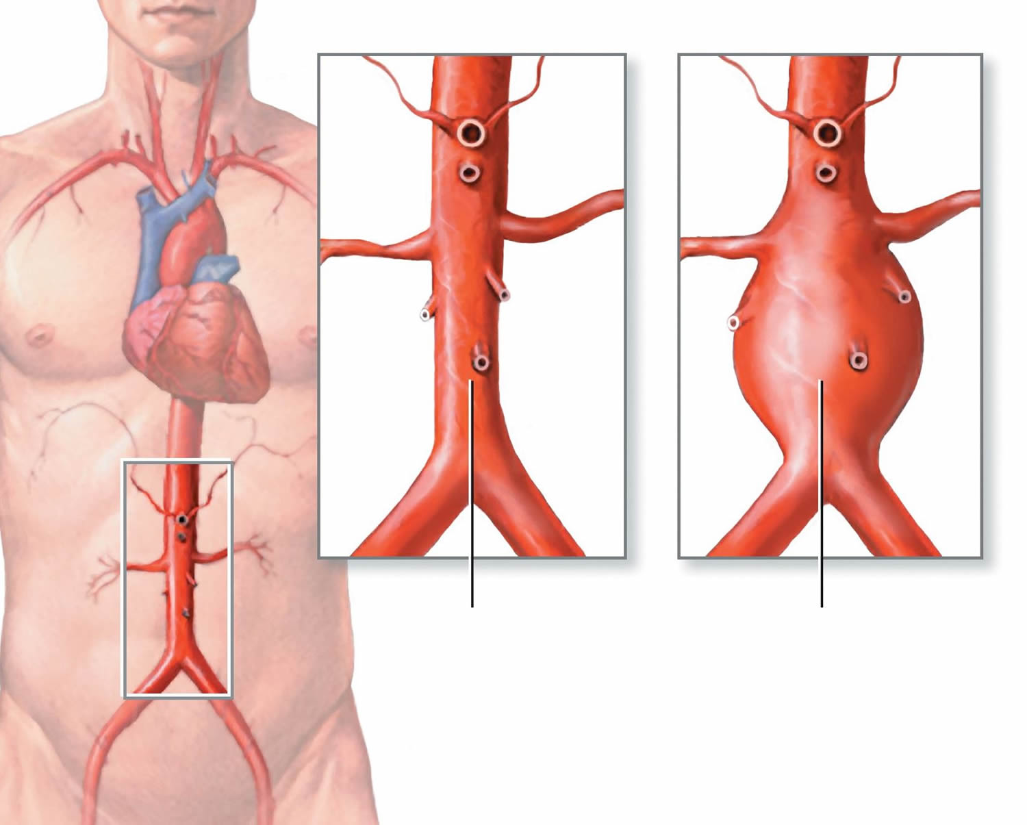 Aortic Aneurysm Abdominal Thoracic Causes Symptoms Repair