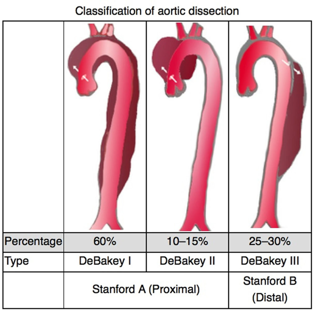 Aortic Dissection - Type A And B - Symptoms, Causes, Treatment