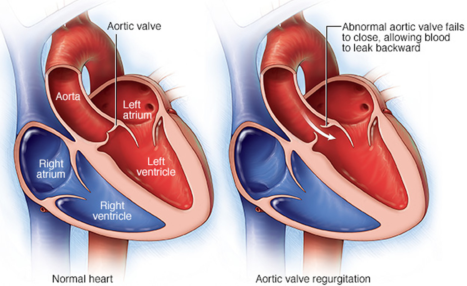 How Do You Fix Aortic Valve Regurgitation