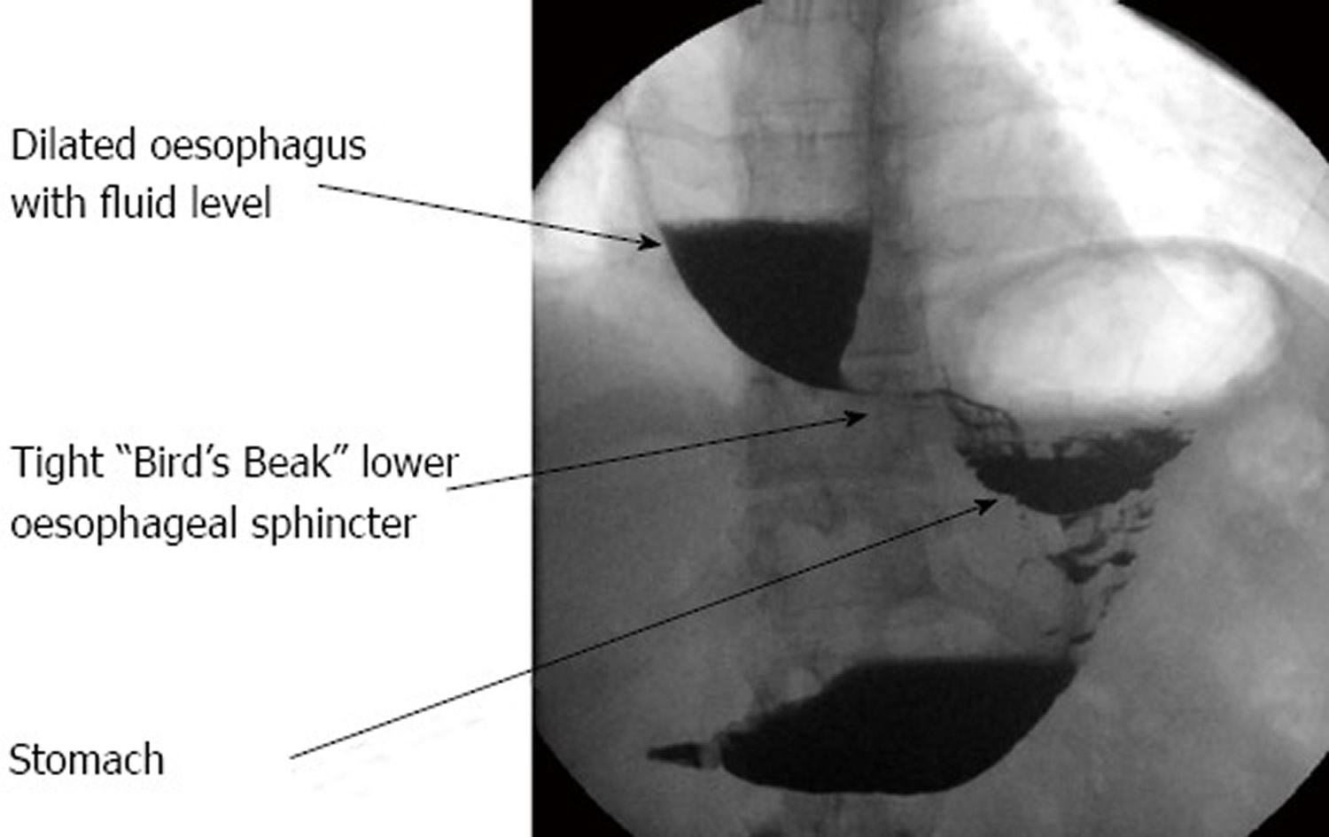 Barium swallow demonstrating achalasia