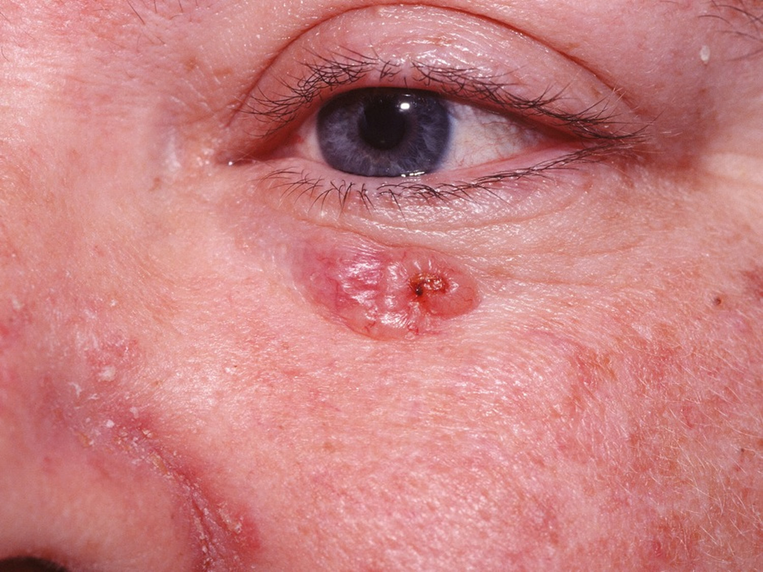 Basal Cell Carcinoma - Causes, Types, Symptoms, Prognosis, Treatment