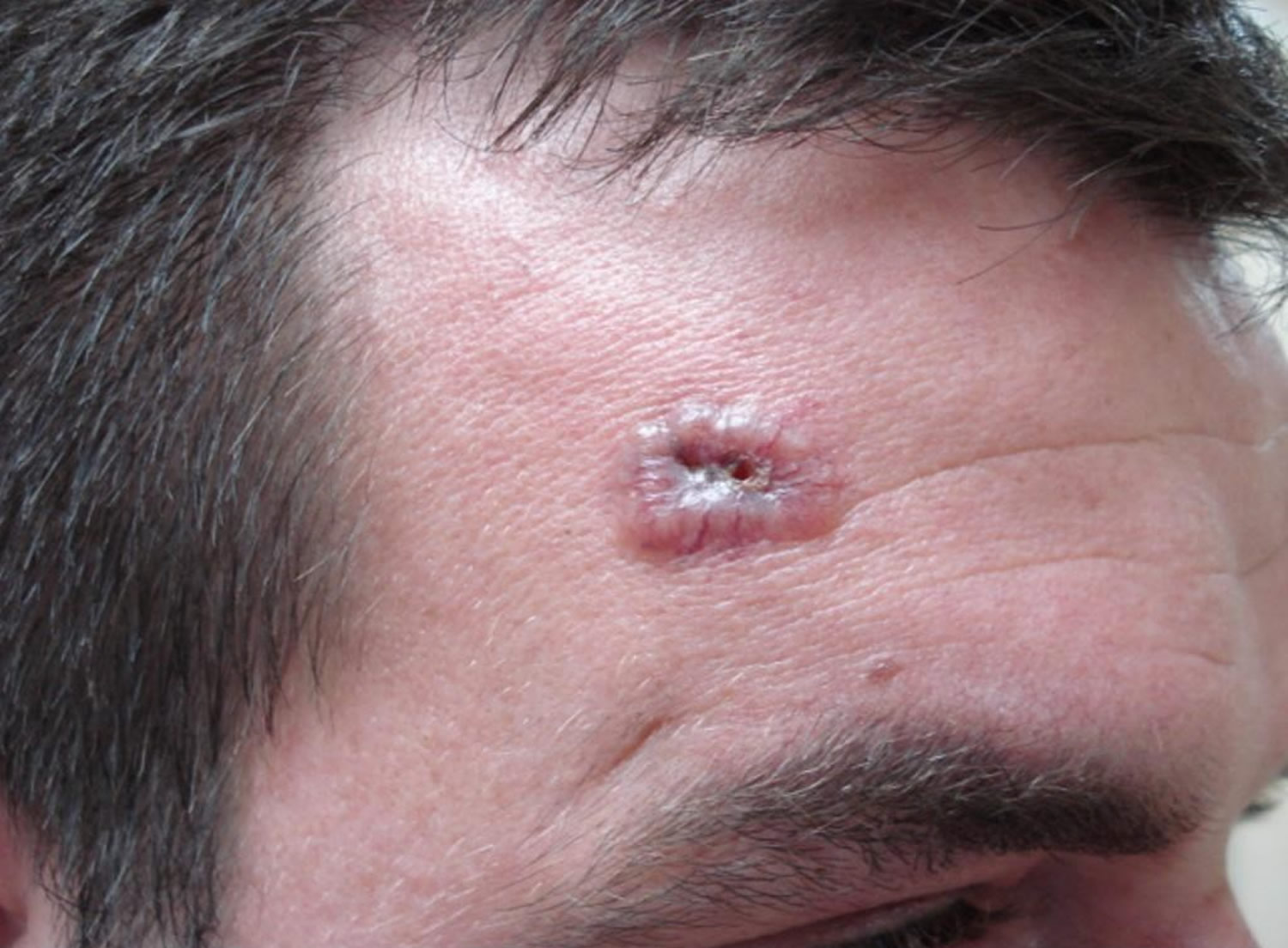 What Does Basal Cell Melanoma Look Like