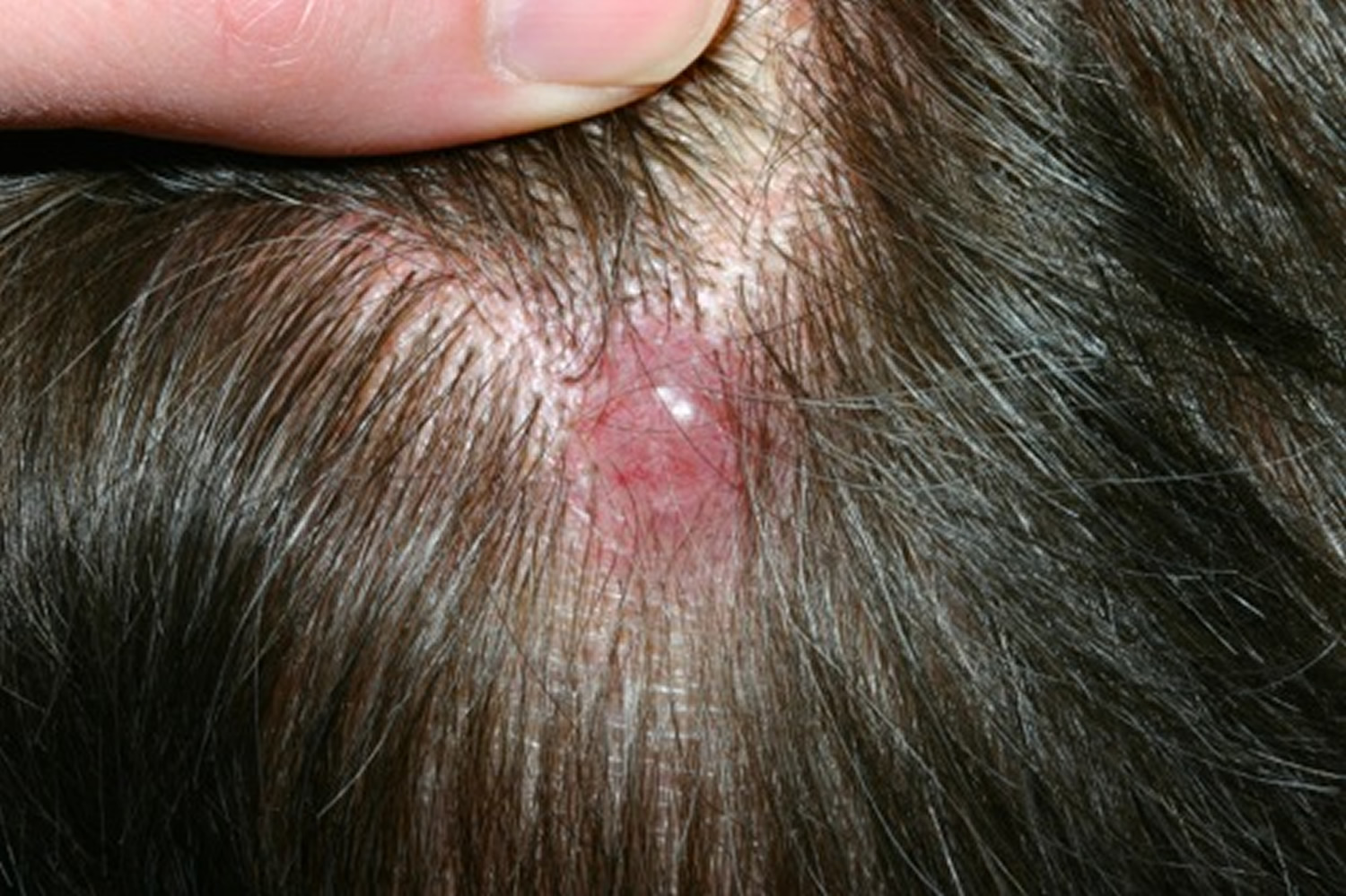itchy skin cancer