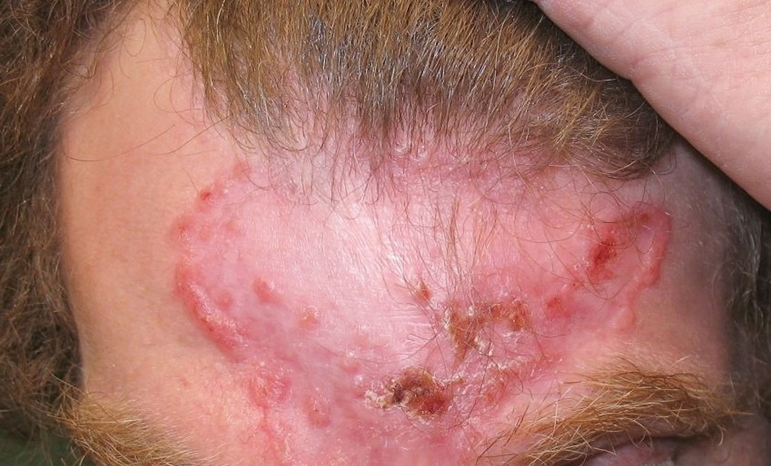 Basal Cell Carcinoma Pictures Scalp