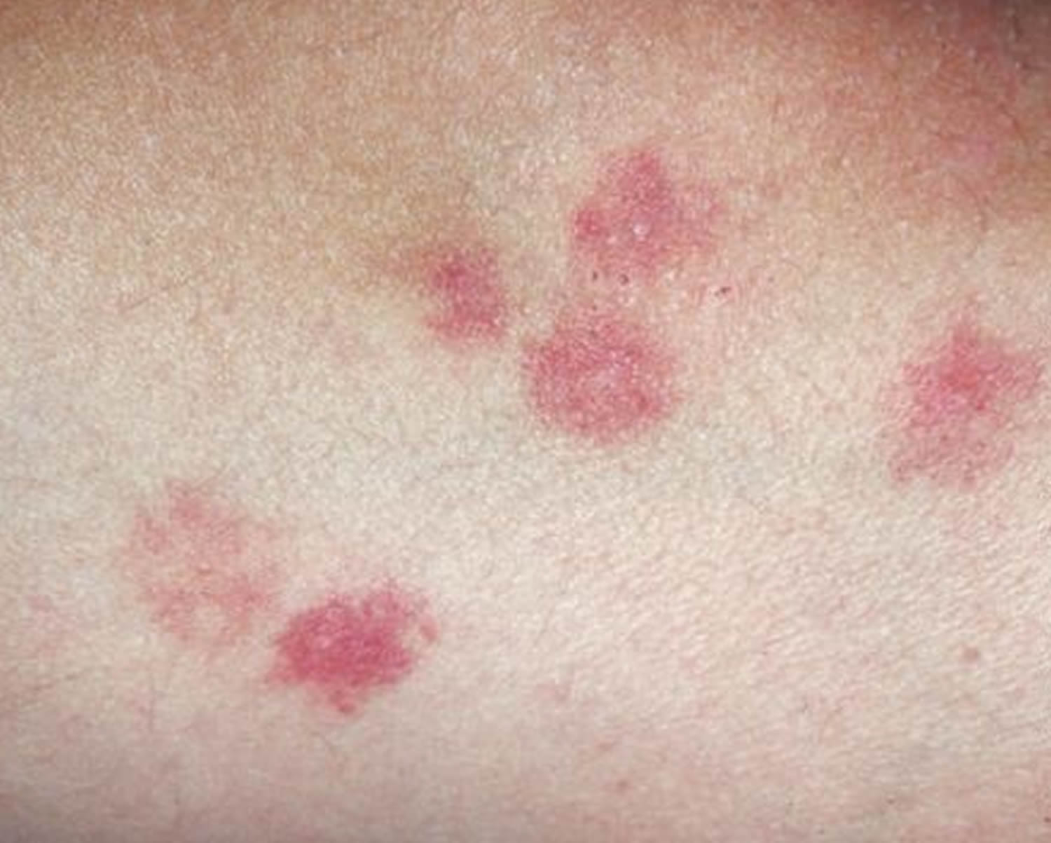 Bed Bug Bites That Don't Itch at Henry Soler blog