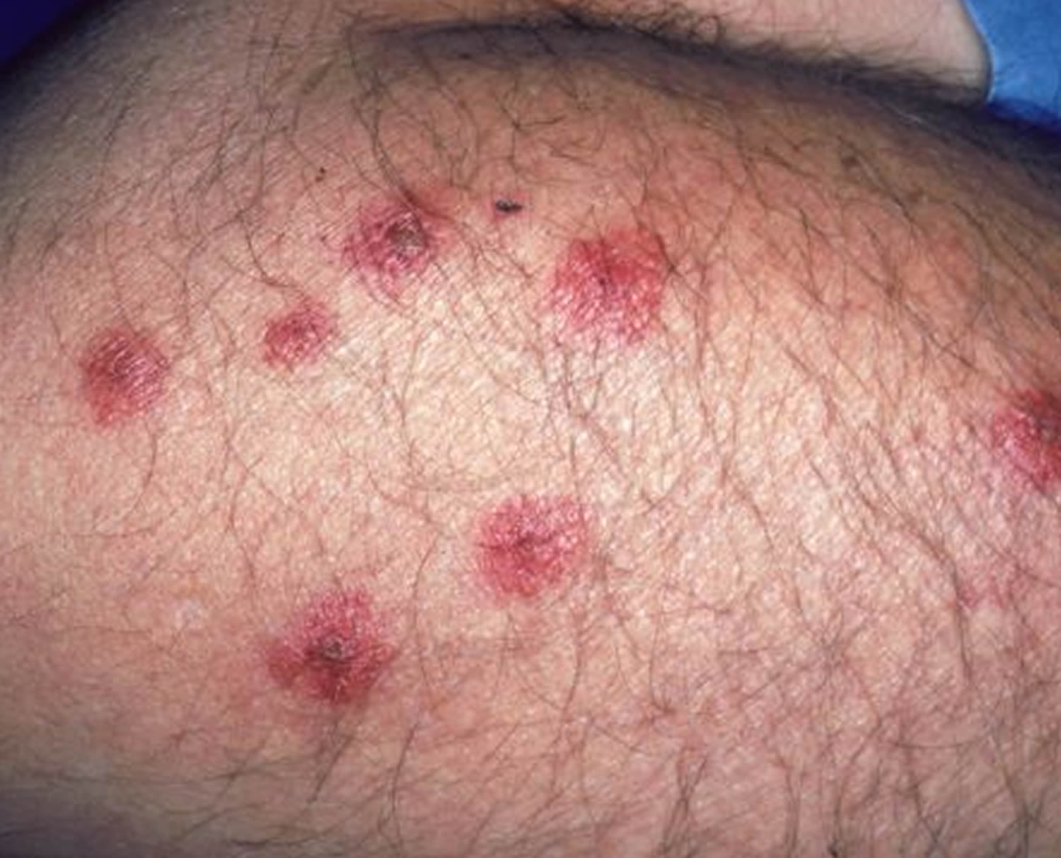 Bed Bugs Bed Bug Bites How To Get Rid Of Bed Bugs   Bed Bugs Rash 