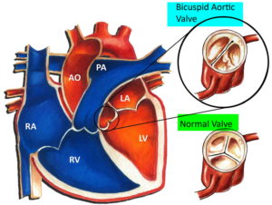 Aortic Valve Disease - Causes, Symptoms, Exercises And Treatment