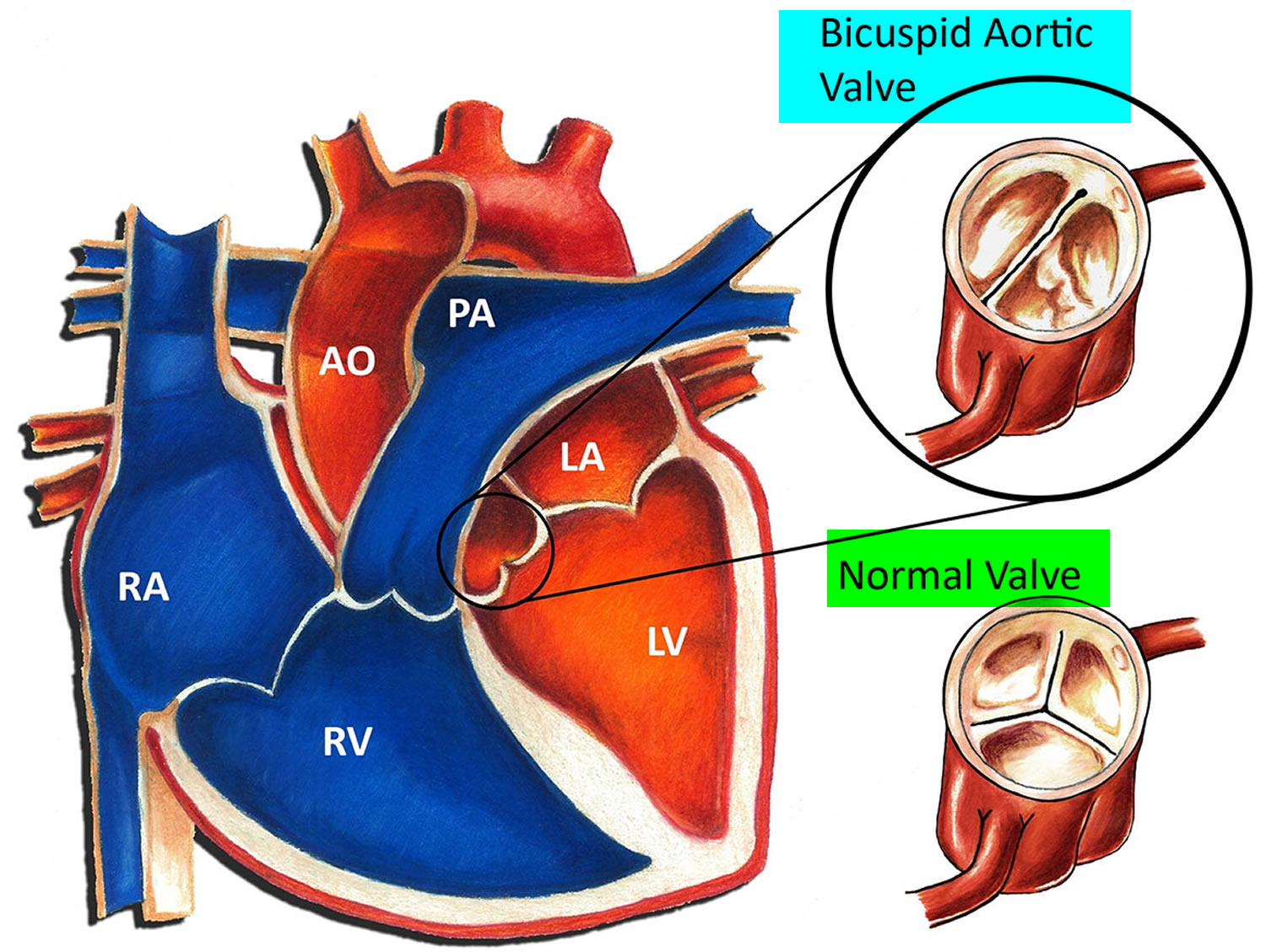 aortic-valve-disease-causes-symptoms-exercises-and-treatment