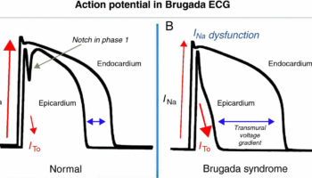 Brugada syndrome ECG action potential