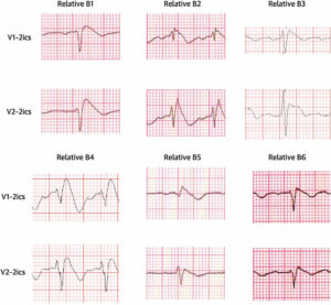 Brugada Syndrome - Causes, ECG, Symptoms, Treatment