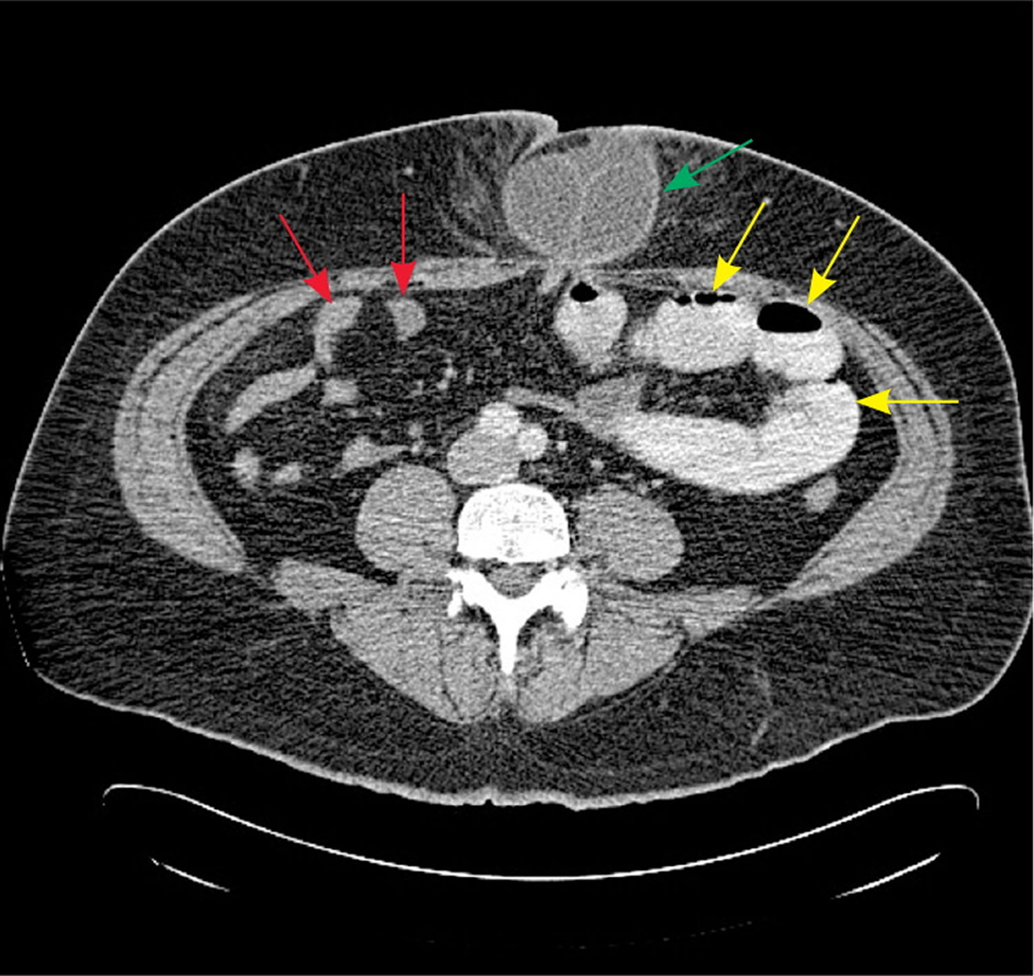 bowel-obstruction-small-large-causes-symptoms-treatment