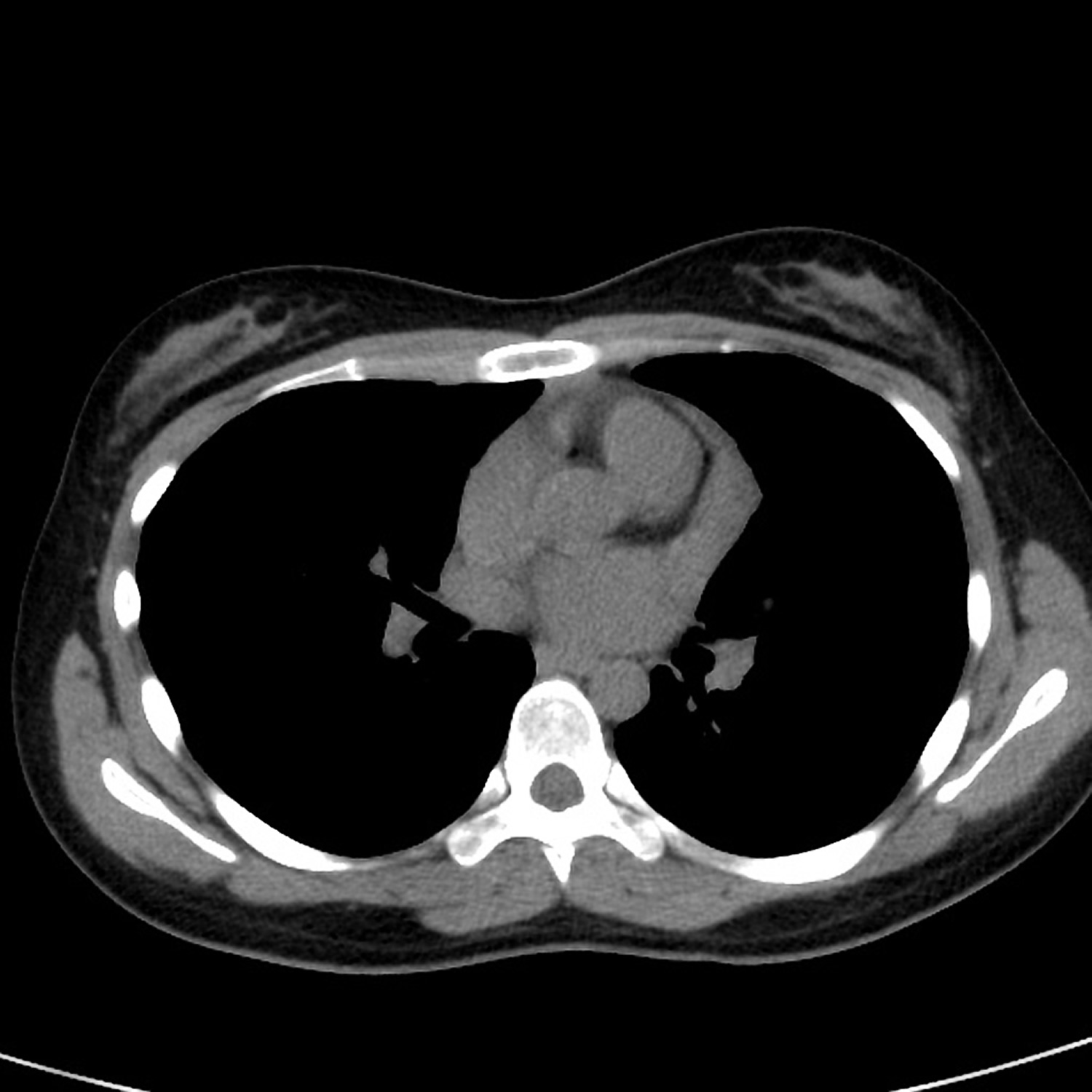 Castleman disease chest CT scan non-contrast