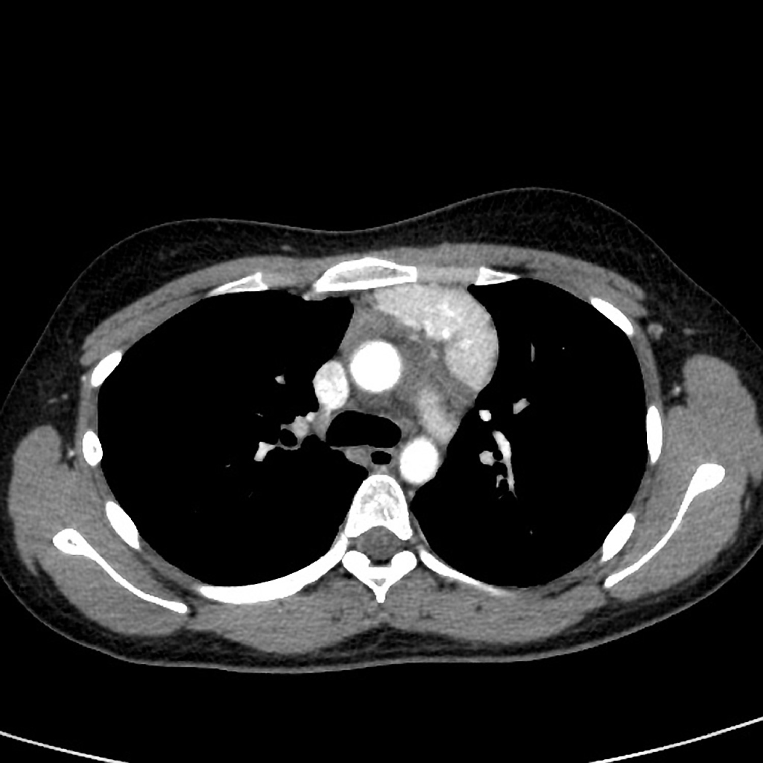 Castleman disease chest CT scan with contrast