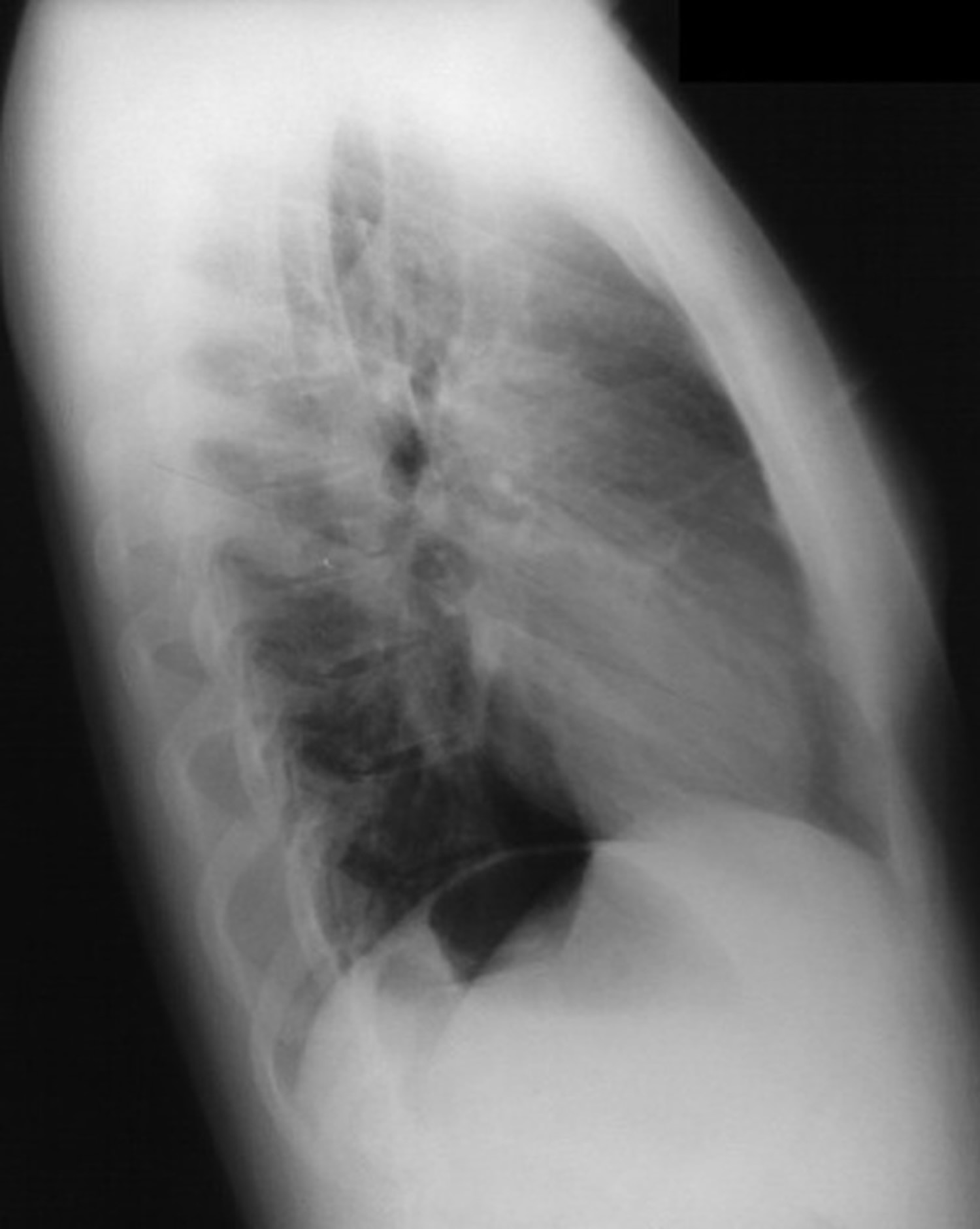 Castleman disease chest x-ray lateral view