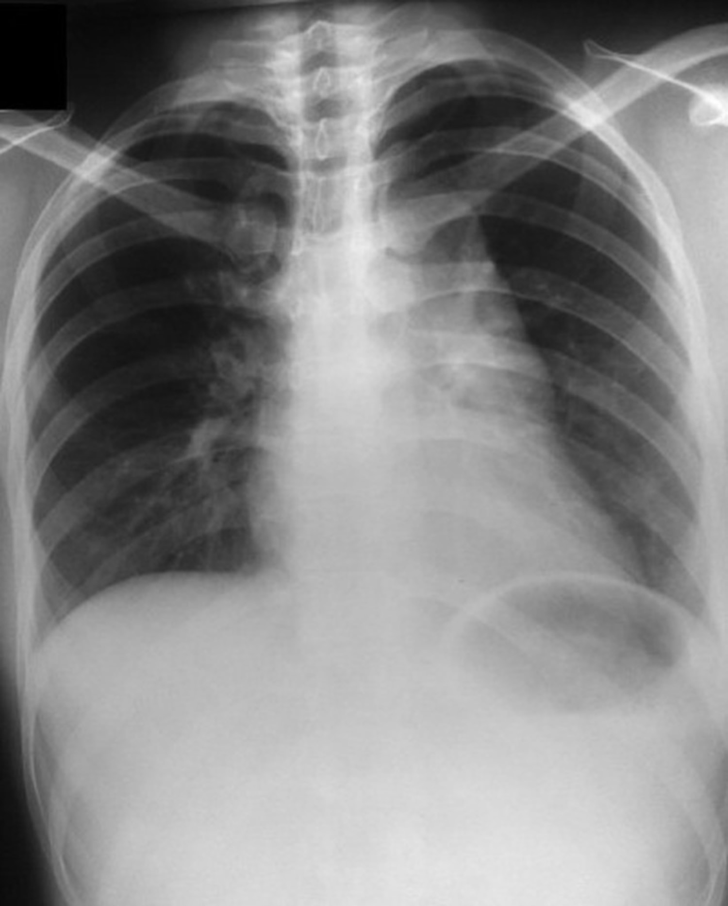 Castleman disease chest x-ray
