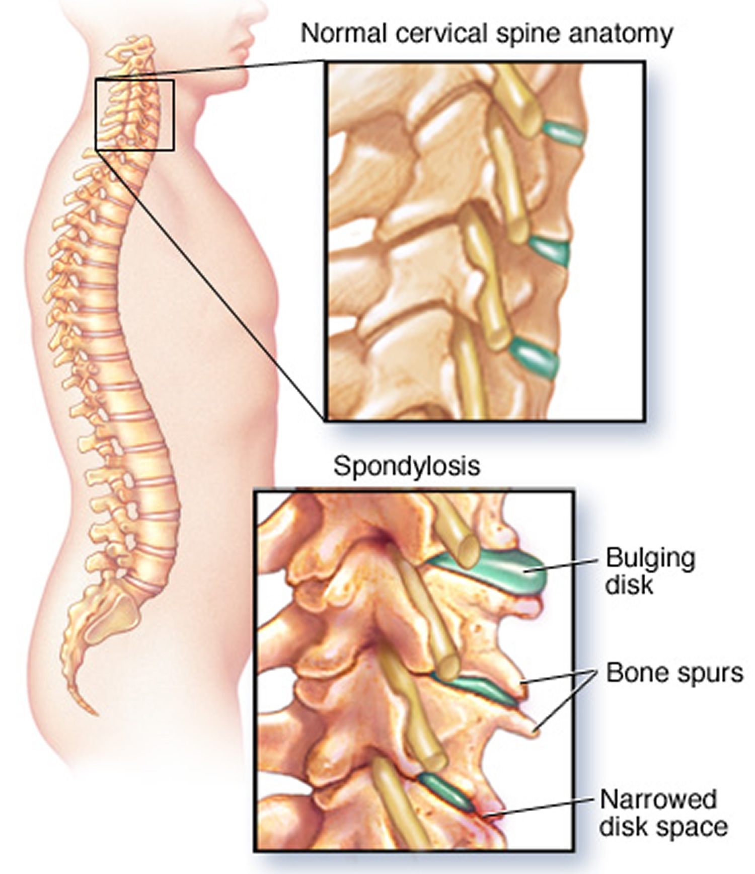 Upper Back Pain Middle Shoulder Pain Causes Treatment