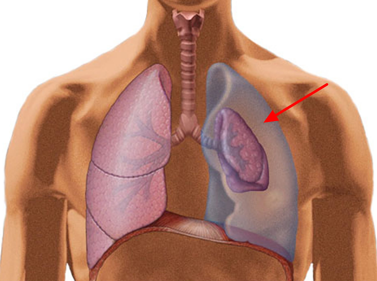 Повреждение легкого ребрами. Плевральная полость пневмоторакс. Пневмоторакс разрыв легкого. Пневмоторакс это коллапс легкого. Пневмоторакс грудной клетки.