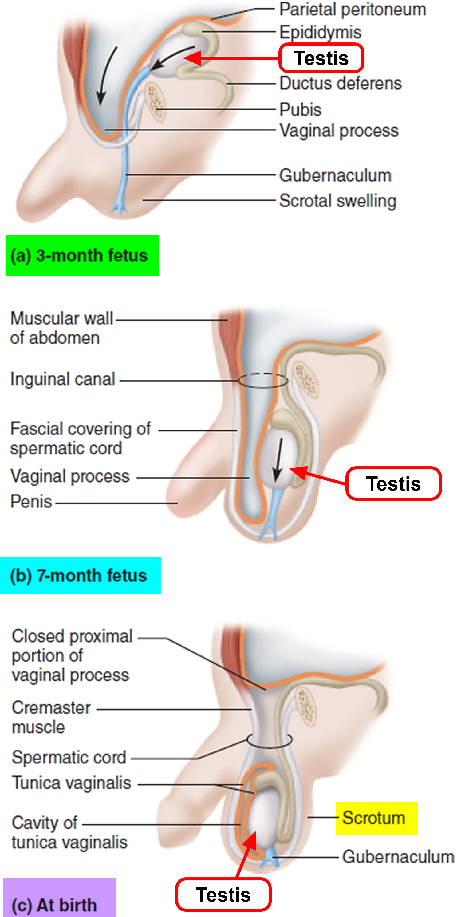 Cryptorchidism