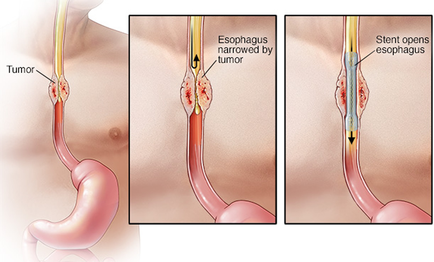 Esophageal stent