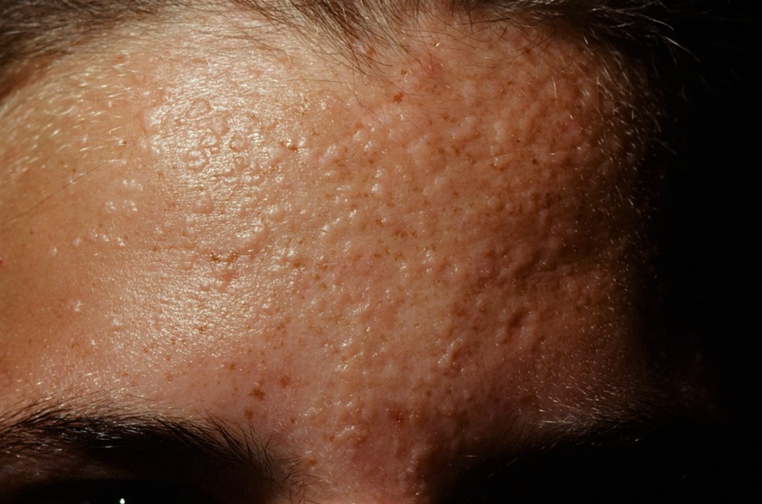 Hpv Flat Warts On Face