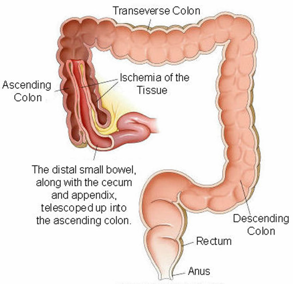 Bowel Obstruction - Small & Large - Causes, Symptoms, Treatment