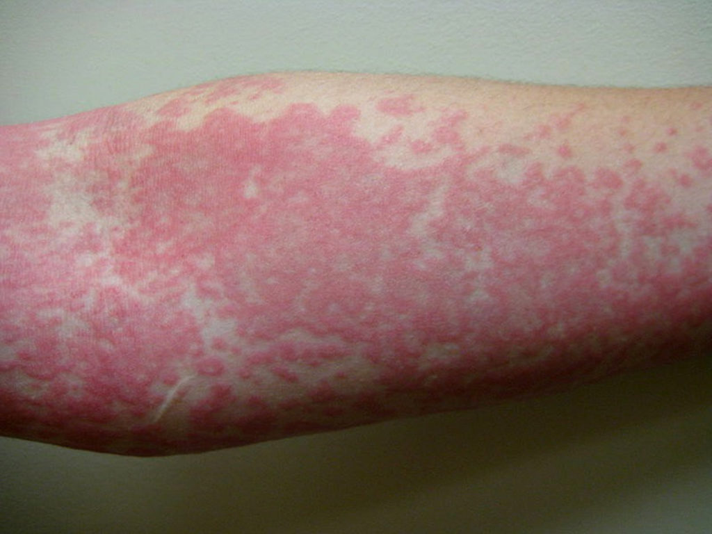 Can Mold Cause Rashes