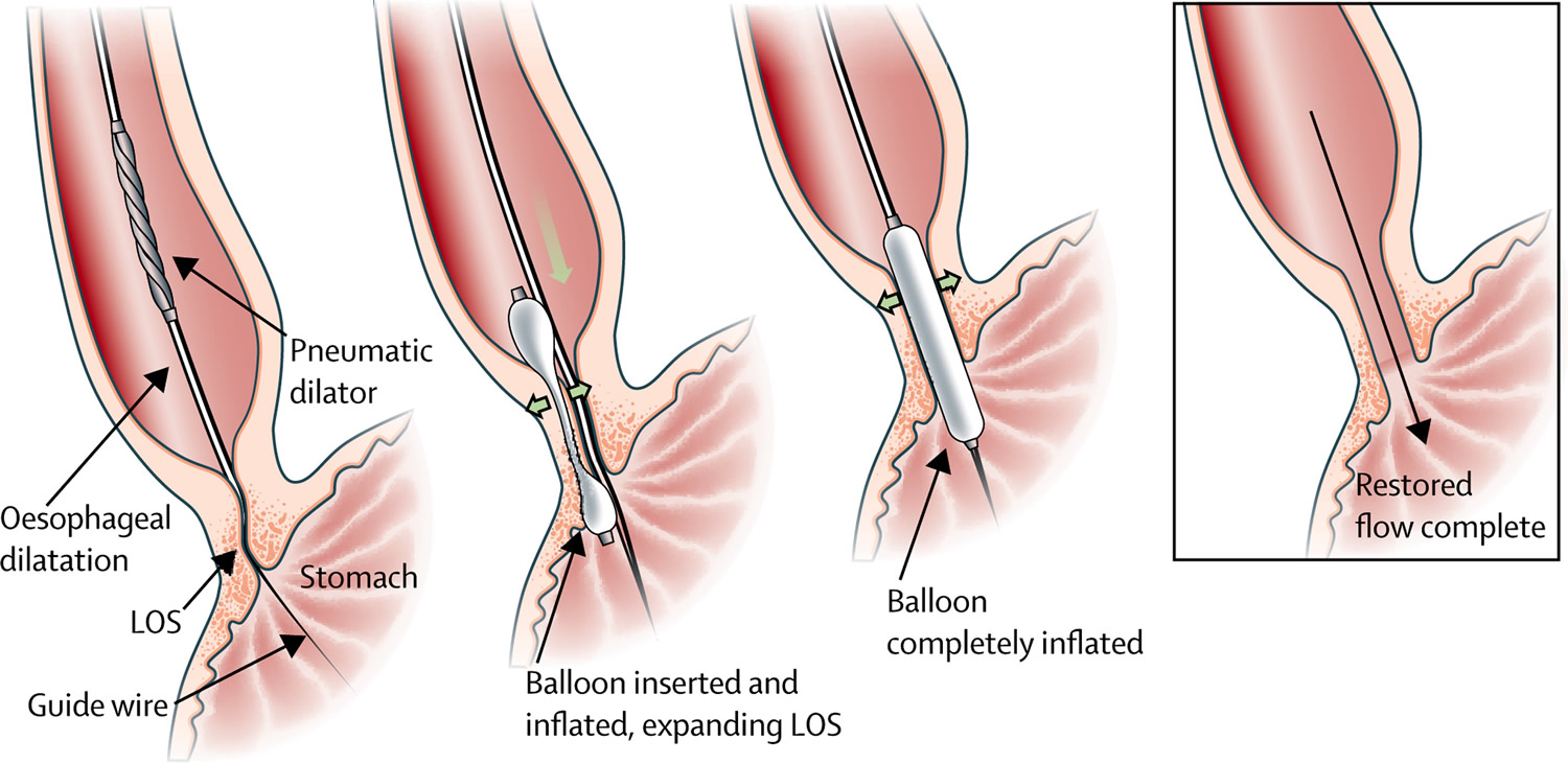 Early rectal stenosis following stapled rectal mucosectomy for hemorrhoids