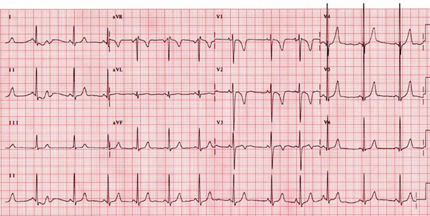 sick-sinus-rhythm-ecg-images-and-photos-finder