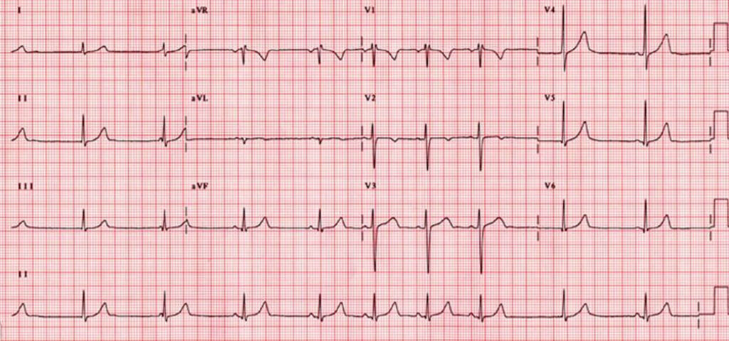 sick sinus syndrome dog ecg