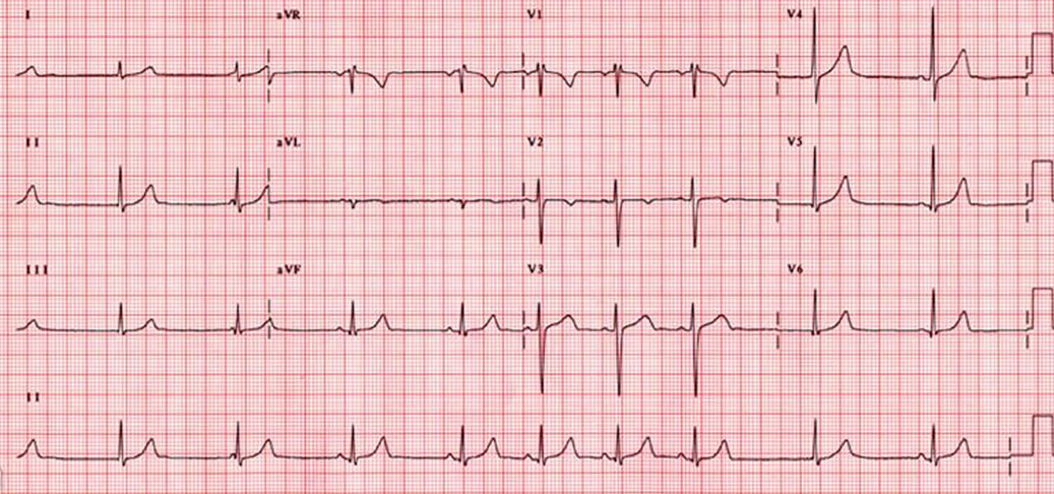 sick sinus syndrome dog ecg