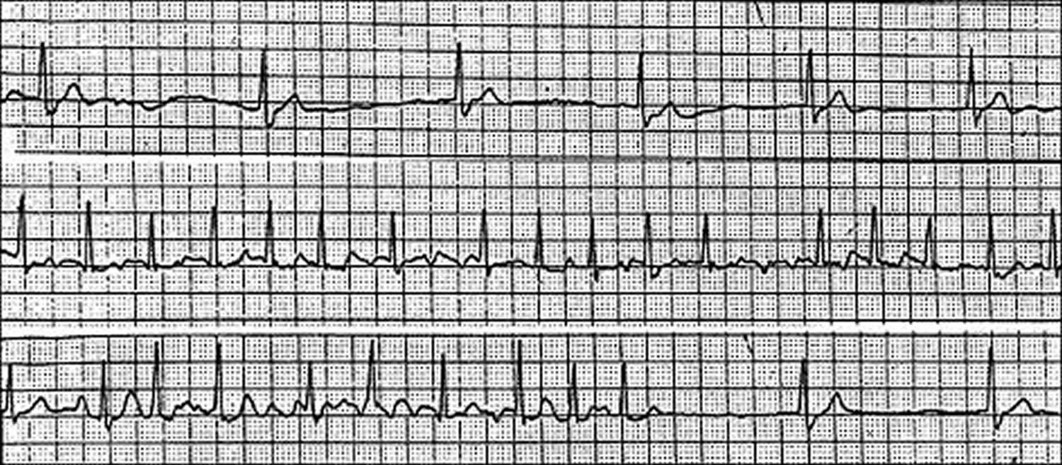 diagnosis and treatment of sick sinus syndrome