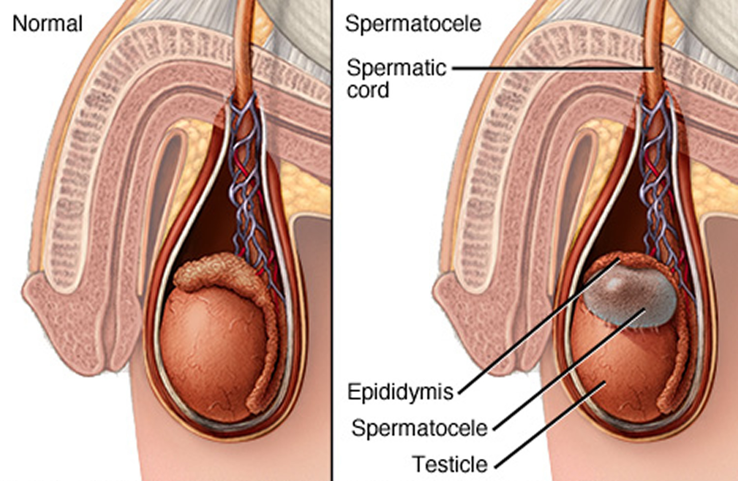 Spermatocele cyst