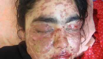 Stevens Johnson Syndrome
