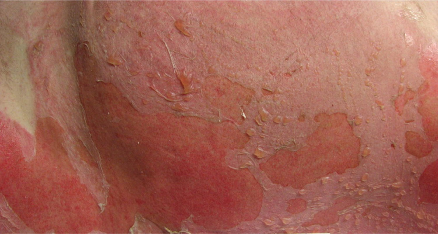 treating second degree sunburn